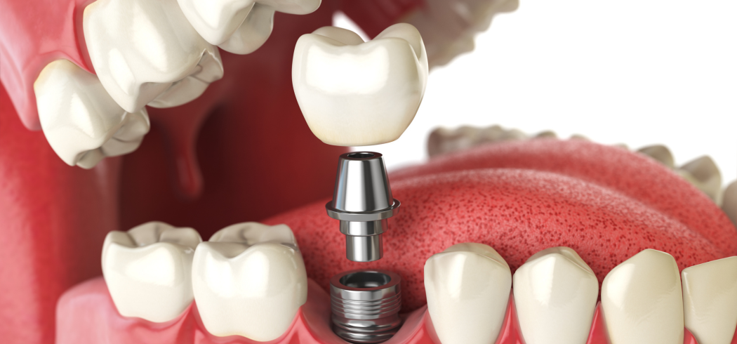 Dental Bridges and Implants