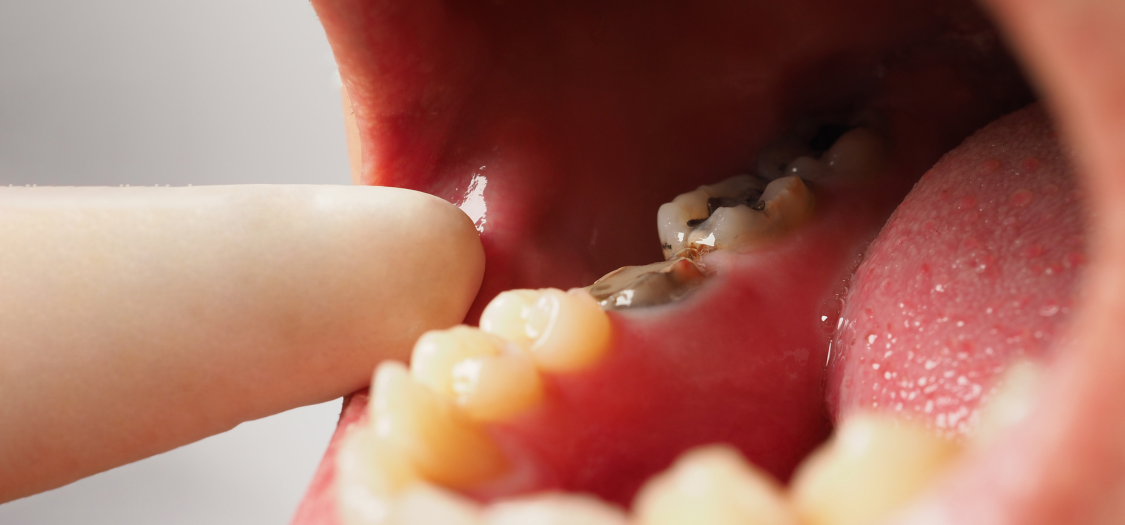 Dental Amalgam Toxicity
