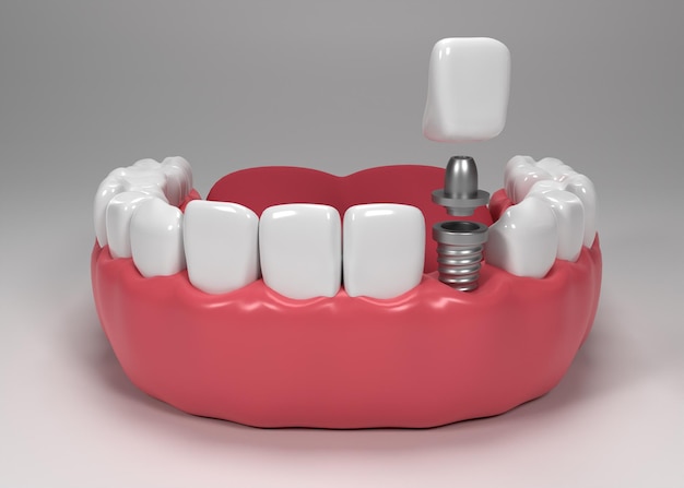Dental Crown