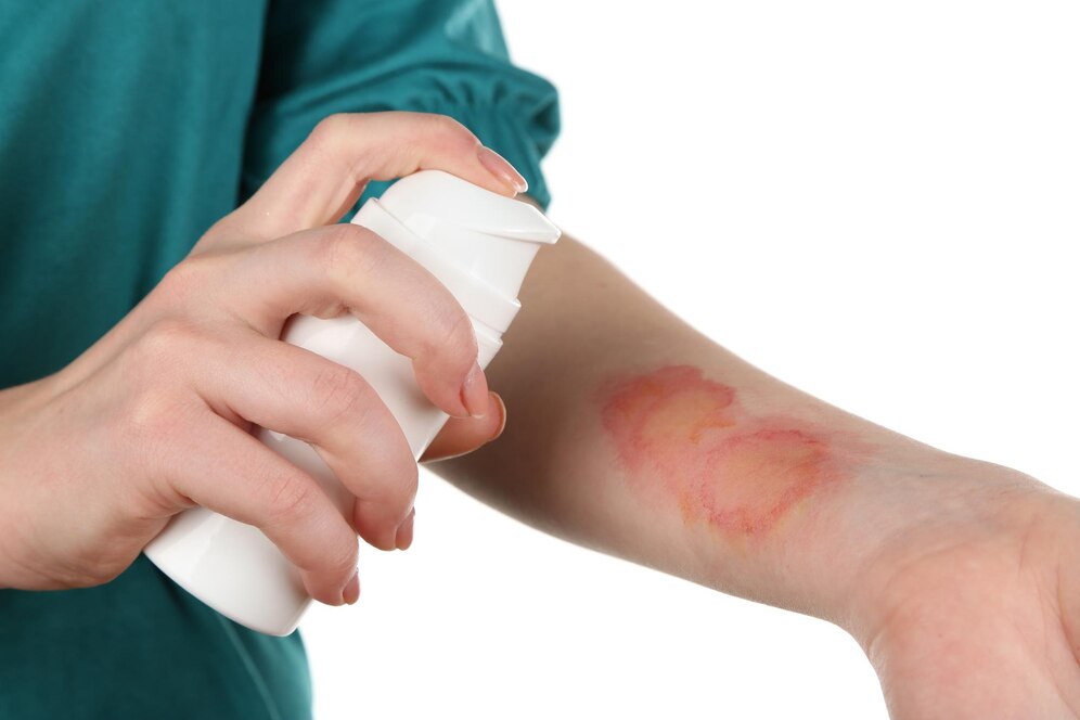 medical burn spray