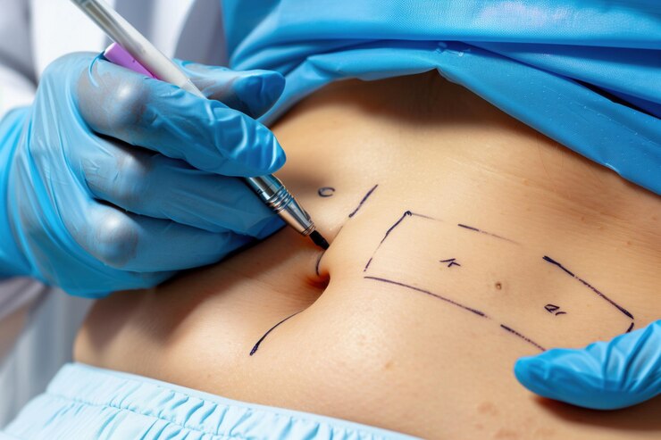 Surgical Skin Marker