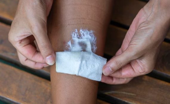 Sterile Burn Dressing