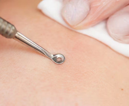 Acne Removal Needles