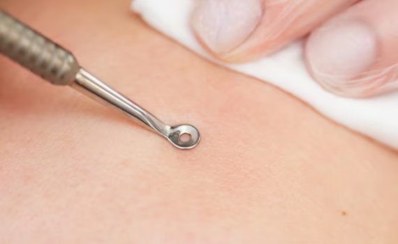 Acne Removal Needles