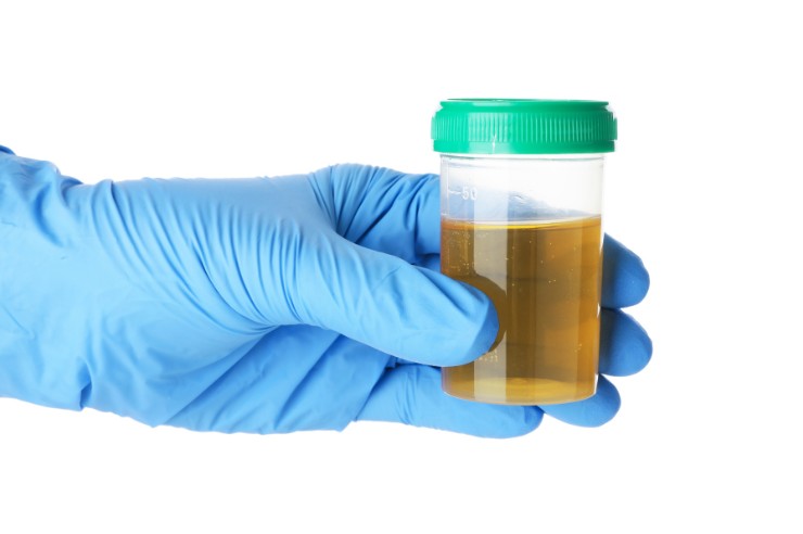 Screw Cap Urine Container