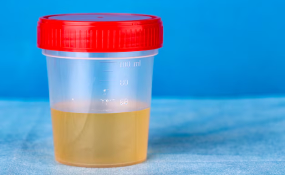 Screw Cap Urine Container