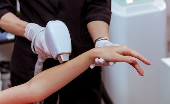 laser hair removal