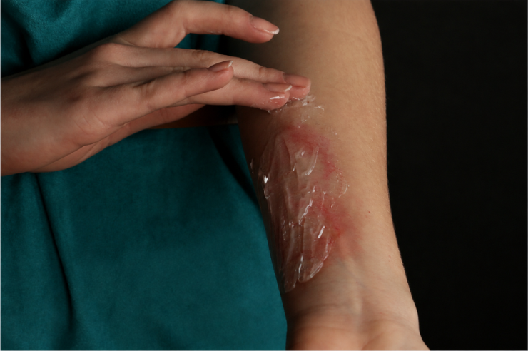 Burn Gel