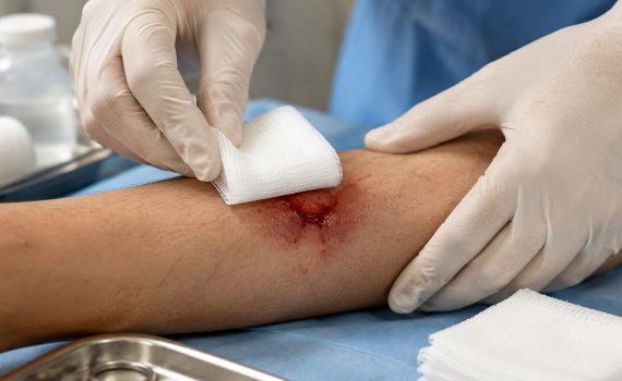 sterile gauze swabs